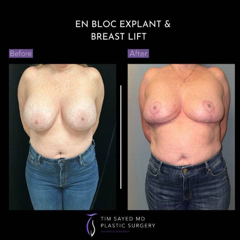 before and after front view en bloc breast implant removal with mastopexy case 8978