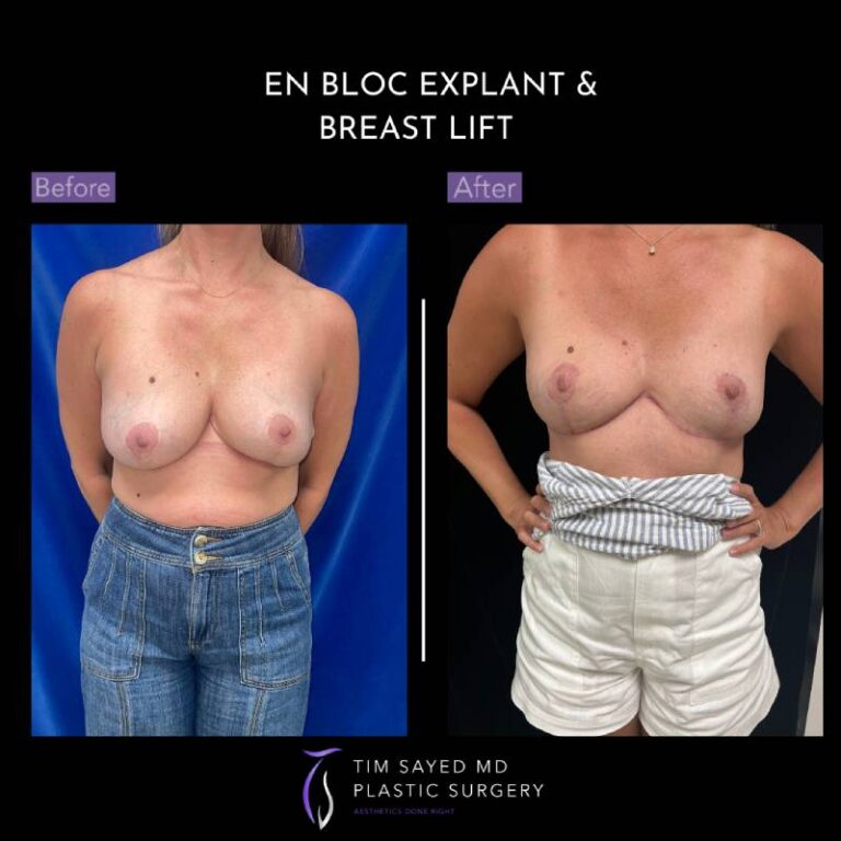 before and after front view en bloc breast implant removal with mastopexy case 8981