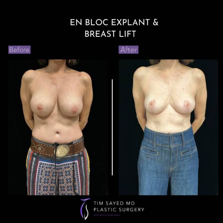 before and after front view en bloc breast implant removal with mastopexy case 8983
