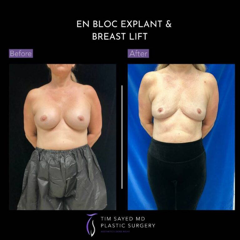 before and after front view en bloc breast implant removal with mastopexy case 8986