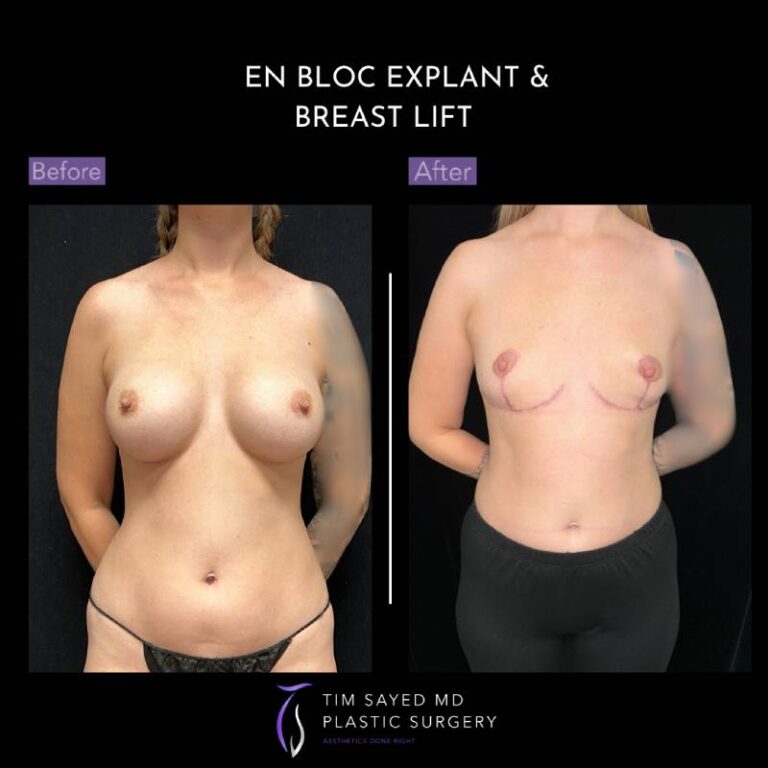 before and after front view en bloc breast implant removal with mastopexy case 8989