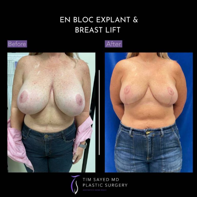 before and after front view en bloc breast implant removal with mastopexy case 9035