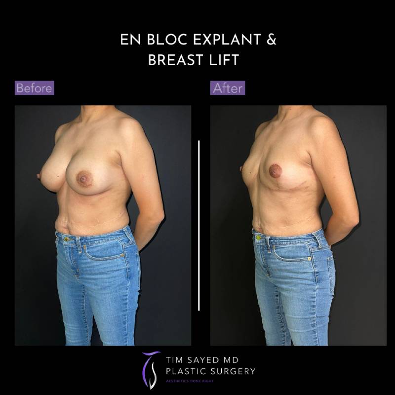 before and after left angle view en bloc breast implant removal with mastopexy case 9042