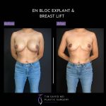 before and after front view en bloc breast implant removal with mastopexy case 9042