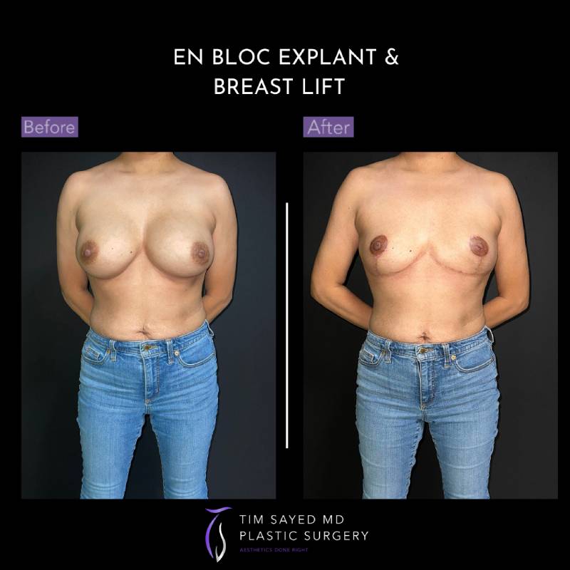 before and after front view en bloc breast implant removal with mastopexy case 9042