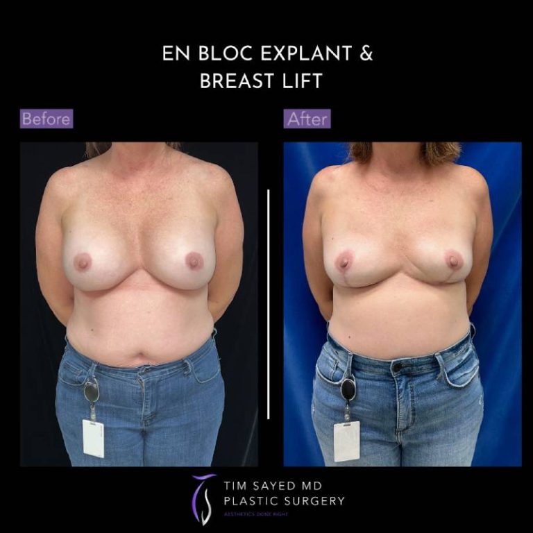 before and after front view en bloc breast implant removal with mastopexy case 9045