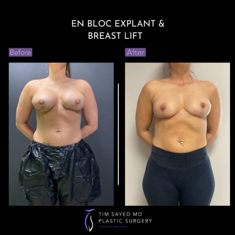 before and after front view en bloc breast implant removal with mastopexy case 9048