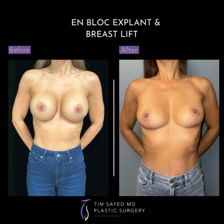 before and after front view en bloc breast implant removal with mastopexy case 9055