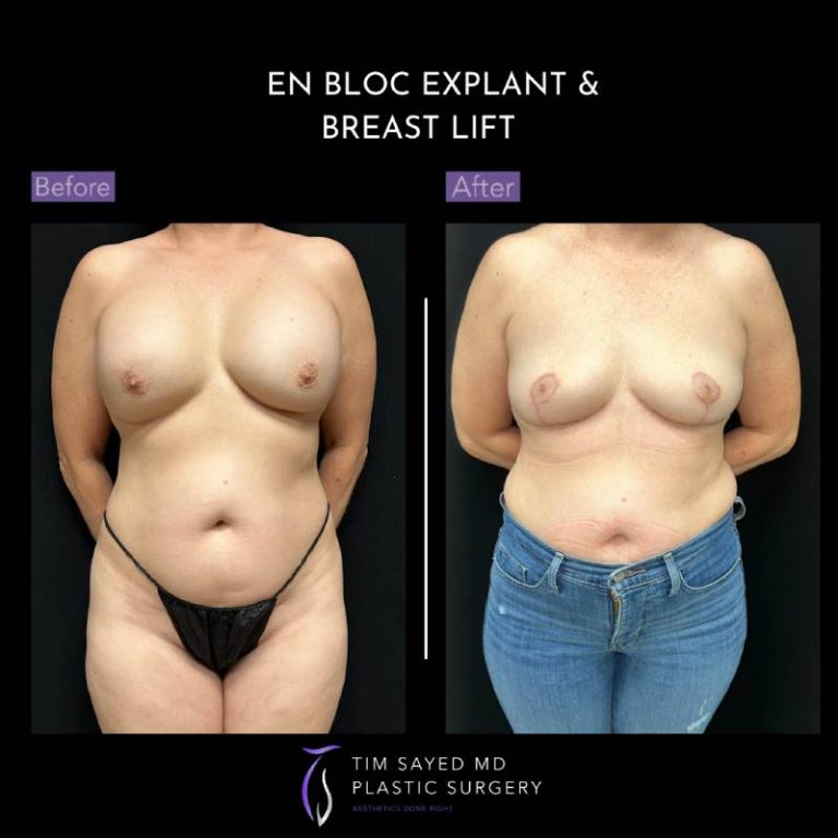 before and after front view en bloc breast implant removal with mastopexy case 9058