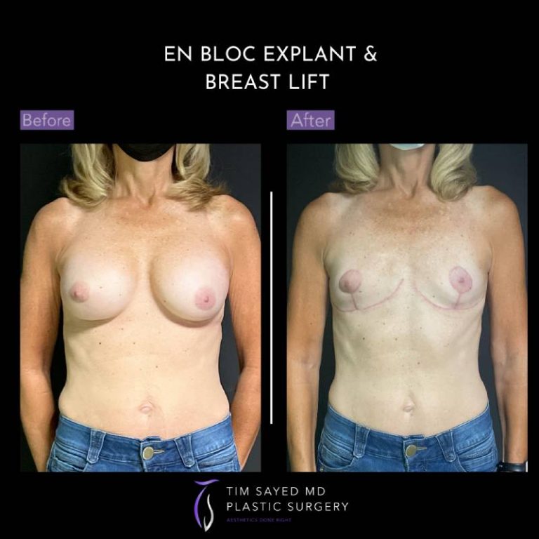 before and after front view en bloc breast implant removal with mastopexy case 9061