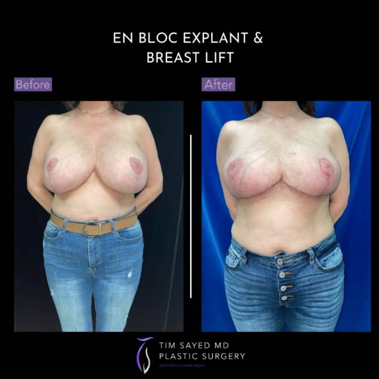 before and after front view en bloc breast implant removal with mastopexy case 9064