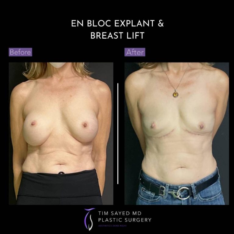 before and after front view en bloc breast implant removal with mastopexy case 9070