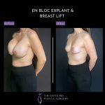 before and after left angle view en bloc breast implant removal with mastopexy case 9080