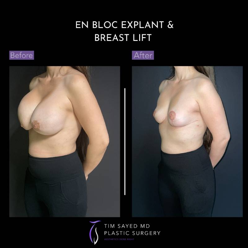 before and after left angle view en bloc breast implant removal with mastopexy case 9080