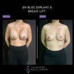 before and after front view en bloc breast implant removal with mastopexy case 9080