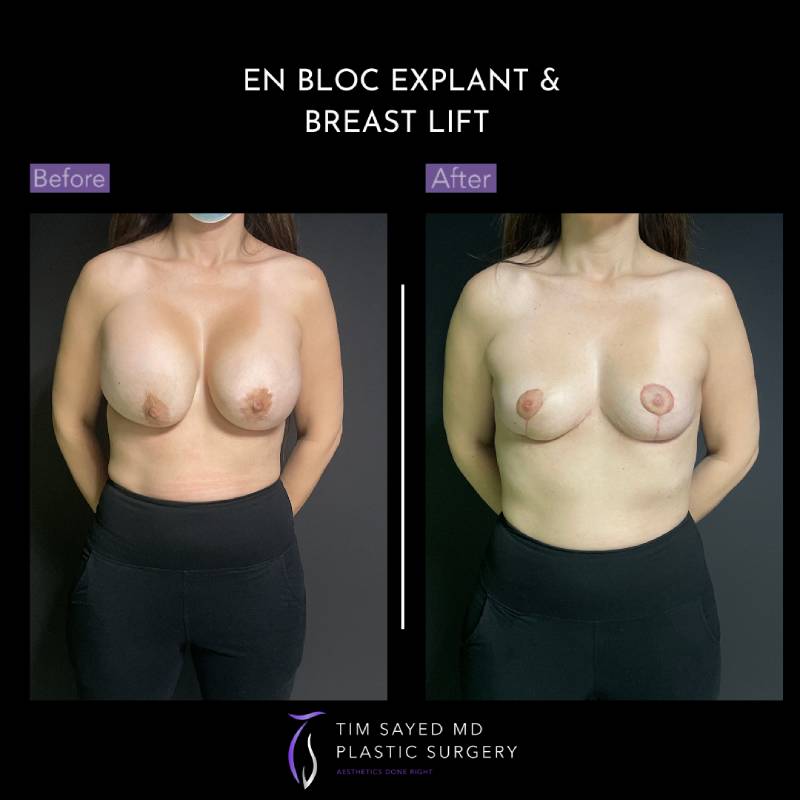 before and after front view en bloc breast implant removal with mastopexy case 9080