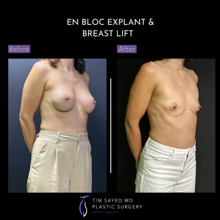 before and after right angle view en bloc breast implant removal with mastopexy case 9083